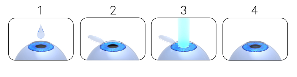 Lasik Surgery LP