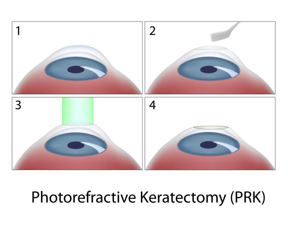PRK Surgery LP